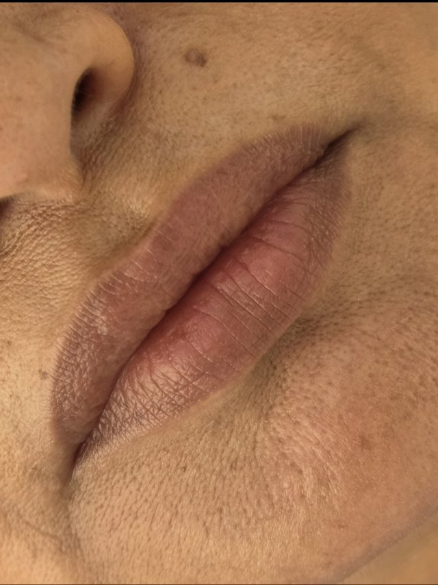 Preenchimento labial, antes
