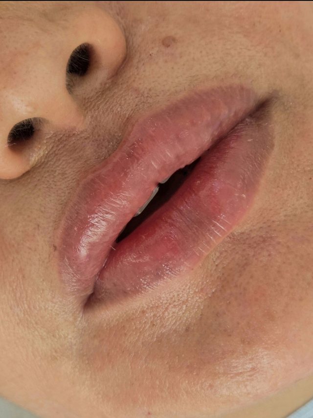 Preenchimento labial, depois