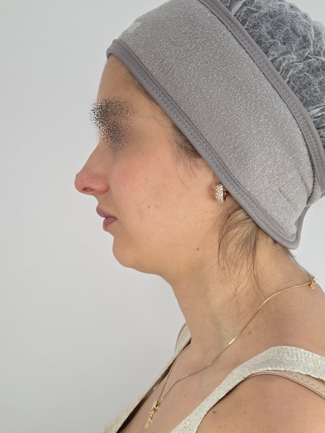 Preenchimento facial, antes