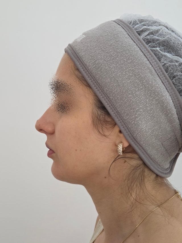 Preenchimento facial, depois